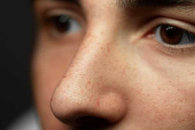 Черные точки на носу: возможные причины и способы избавления