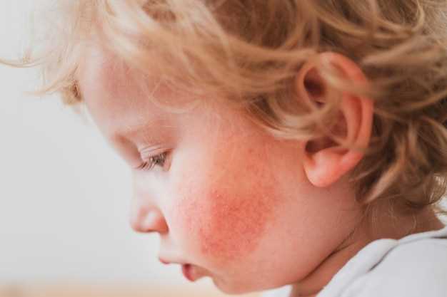 Как начинается краснуха у детей: первые симптомы и признаки